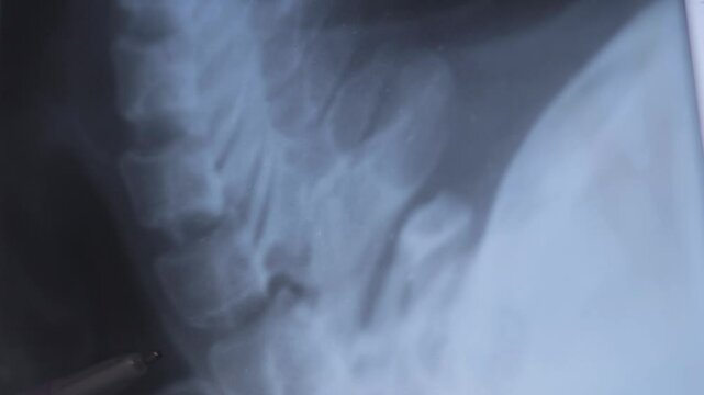 Close up video, Doctor learn X-rays for Diagnosing Whiplash Injuries of Cervical spine. Trauma of Axial skeleton. 4k footage.