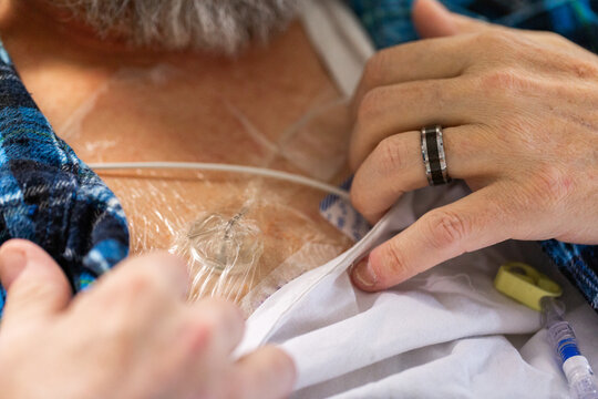 Cancer patient in hospital with portacath medical device in chest - Port-a-cath (Port)