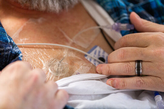 Cancer patient in hospital with portacath medical device in chest - Port-a-cath (Port)