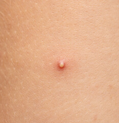 Fototapeta premium A small red bump on a person's arm