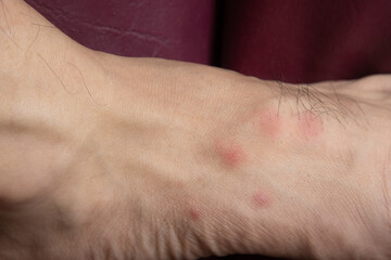 The blisters are red and itchy on the patient's skin that are caused by bites from pet fleas