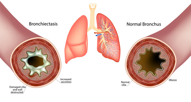 Bronchiectasis and Normal Bronchus. Increased secretion Mucus. Wall destructed and Damaged cilia  Bronchus