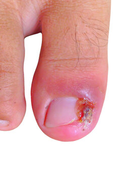 Ingrown nails or Ingrown toenails,by bacteria causing inflammation A burning pain in the toe should require surgical treatment at a medical facility.Ingrown toenails isolated. toenail avulsed isolated