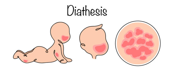 Diathesis