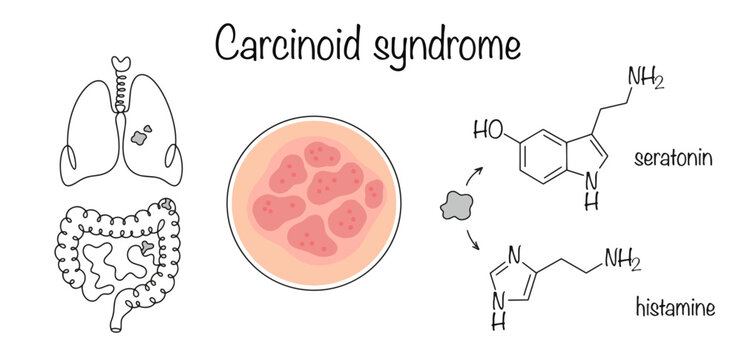 Carcinoid syndrome