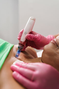 Professional Performing Microneedling on Patient
