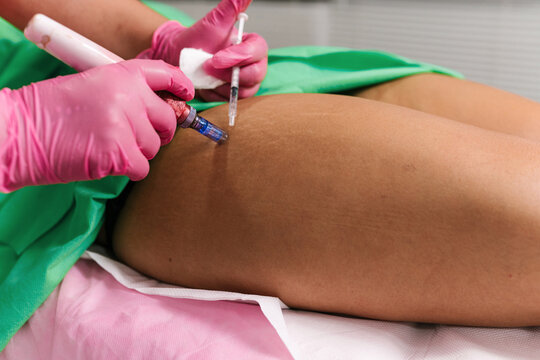 Thigh Treatment with Microneedling and Injection
