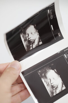 A hand holds up two ultrasound images