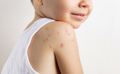 adorable baby boy with lot of insects bites on shoulder isolated on clean backdrop. cute kid child...