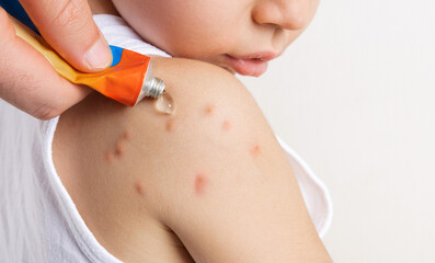 adorable baby boy with lot of insects bites on shoulder isolated on clean backdrop. cute kid child with many red bumps and doctor or father dad hand applying treatment gel.close up, space for text