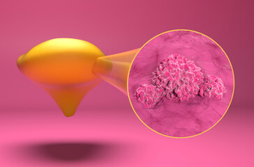 Bladder cancer - isometric view 3d illustration