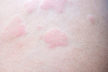 Skin allergy rash dermatitis texture close up