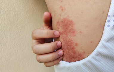 portrait the rash, hives, allergy and inflammation skin, reaction and urticaria, eczema and epidermis, allergic and psoriasis on the back, health care and medical concept.