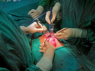 Surgery of abdominal, Resection of Small Bowels with Ligation of vessels during operation. Step by step surgery.