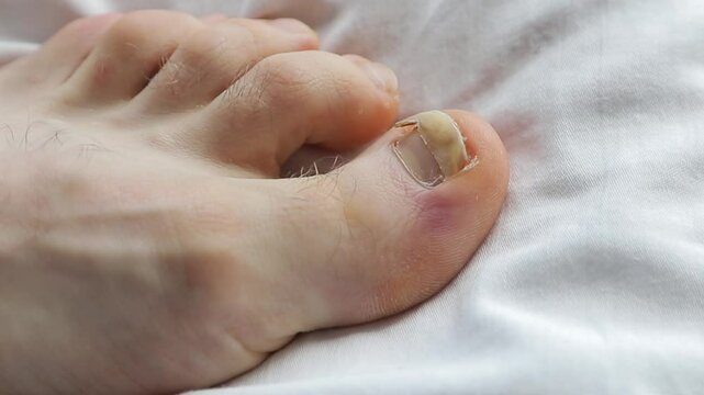 A close-up of a damaged toenail after trauma, bruise, photographed indoors on a fabric background. Concept of personal hygiene and the care of nail health and recovery from damage or infection.