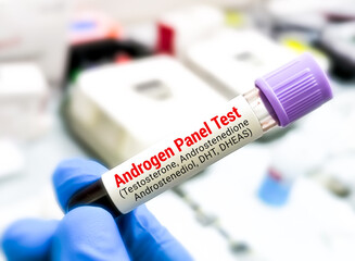 Blood sample for Androgen test, a group of hormone test including testosterone,...