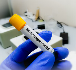 Blood sample in scientist hand for Serum Androgen Index test.