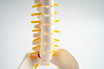 Lumbar spine displaced herniated disc fragment, spinal nerve and bone. Model for treatment medical...