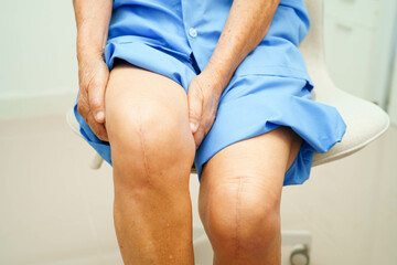 Asian elderly woman patient with scar knee replacement surgery in hospital.