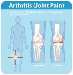 Understanding Arthritis and Joint Pain