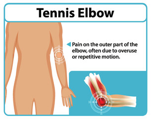 Understanding Tennis Elbow Pain