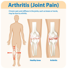 Understanding Arthritis and Joint Pain