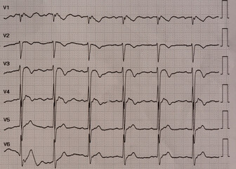 Electrocardiogram showing multiple leads with inverted T waveforms in V1- to V4 lead indicating myocardial ischemia from coronary stenosis.