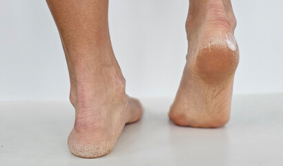 Foot care treatment process showing dry skin on soles and heels