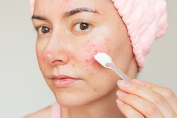 A young Caucasian woman with a pink headband suffering from chronic rosacea disease in the acute...