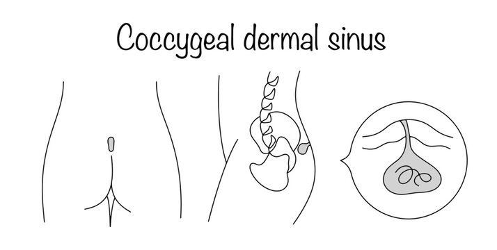 Coccygeal dermal sinus