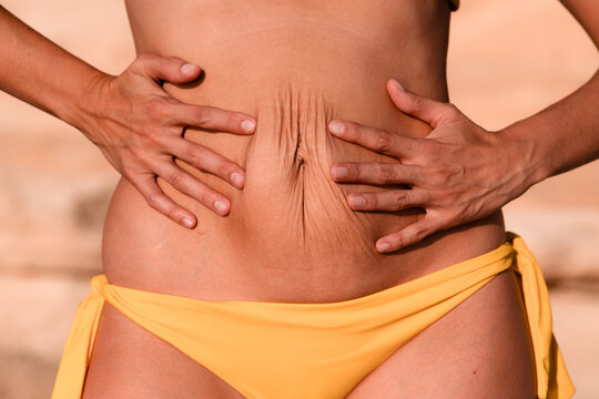 Close up of squeezed belly skin in a woman with diastasis