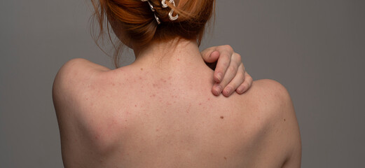 Skin acne, pimples background. Acne problem on back. Dermatology and cosmetology. Pimple on back. Pimp. Sensitive skin. Acne skin.