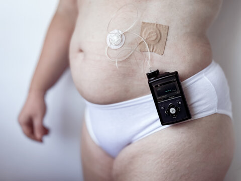 Person with insulin pump and glucose monitor for diabetes management