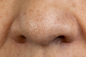 senior woman worry about enlarged pores skin and blackhead on face.