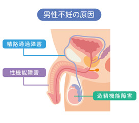男性不妊の原因　不妊症　生殖医療