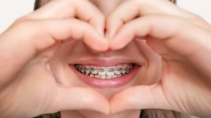 Braces Teeth Smile in Heart Hands. Alignment of Bite of Teeth. Happy Child Smile with Braces. Close...