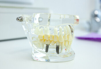 Dental implants showing on anatomical model in clinic