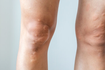 Young asian man has allergic skin rash on his legs from itchy dry skin eczema dermatitis insect bites