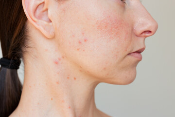 Close-up profile of a young woman suffering rosacea in acute stage on her cheeks and acne on the...
