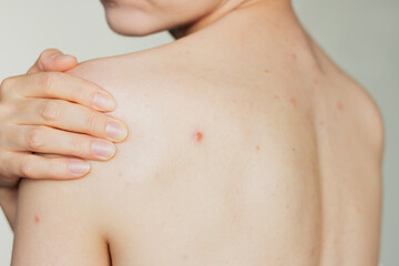 Young woman suffering acne on her back, demonstrating a big pimple on her shoulder blade. Skin...