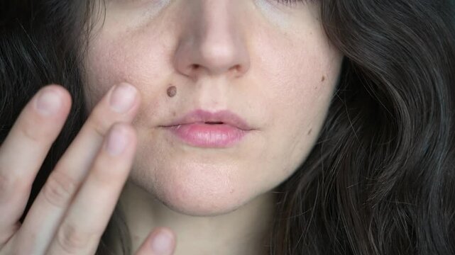 A girl touches two large moles on her face with her hands