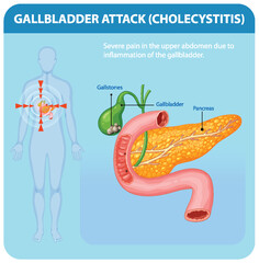 Understanding Gallbladder Attack and Cholecystitis