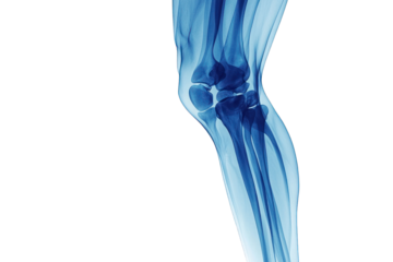 X-ray of knees focusing on joint health, detecting injuries or degenerative diseases, isolated on transparent and white background.PNG image	
 