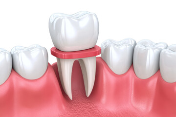 Tooth crown placement for damaged teeth, restoring appearance isolated on transparent and white background.PNG image	
