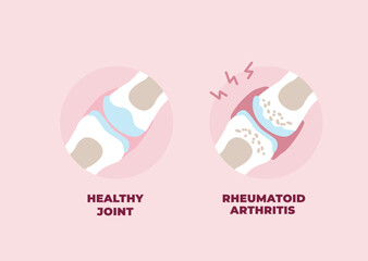 Healthy and inflamed joint affected by Rheumatoid Arthritis. Vector illustration in flat style.