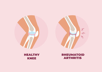 Healthy knee and inflamed knee joint affected by Rheumatoid Arthritis. Vector illustration in flat style.