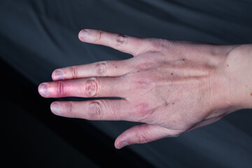 Mallet finger healing after splint removal from middle finger following joint trauma