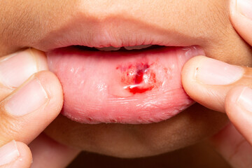 Woman showing bleeding wound inside lower lip: close-up of mouth injury