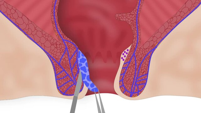 Milligan-Morgan hemorrhoidectomy