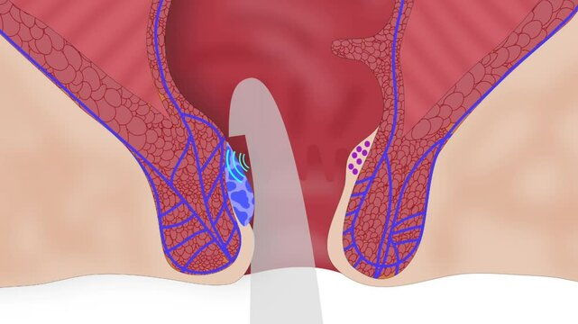 Hemorrhoid artery ligation-rectoanal repair HAL RAR